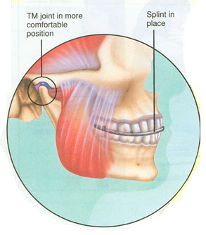 TMJ Treatments